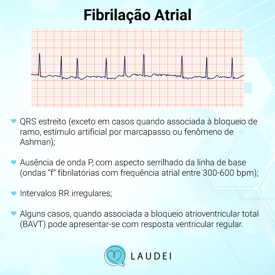 Arritmia Fibrilação Atrial Laudei